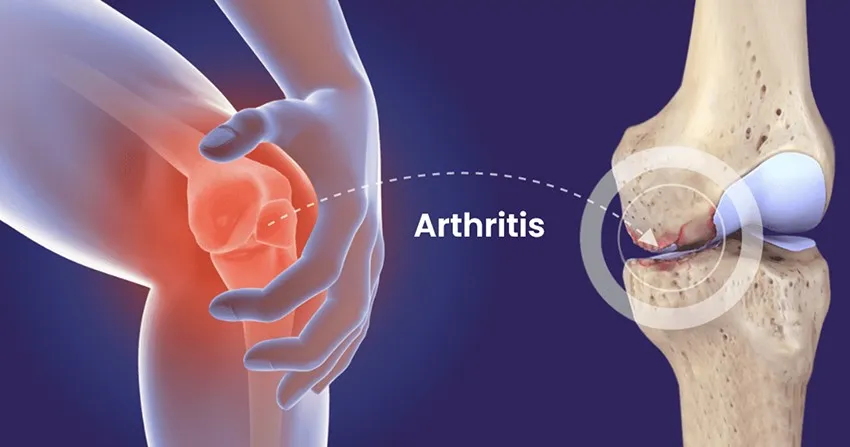 Arthritis
